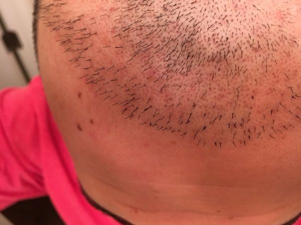 Hair Transplant · South Korea
