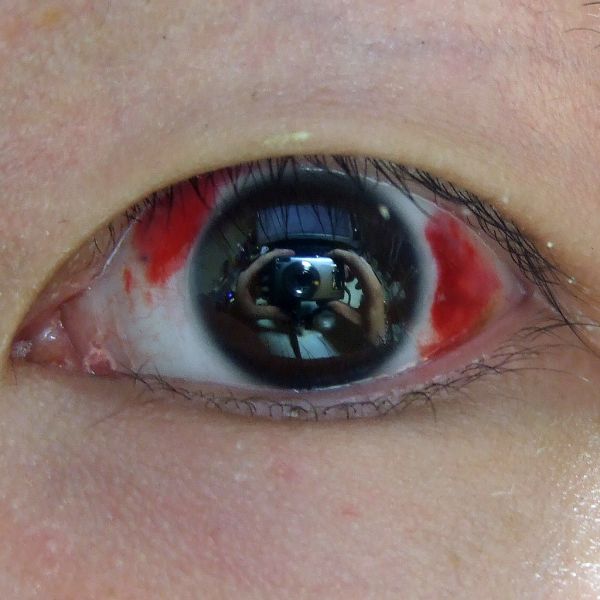LASIK Eye Surgery · Turkey
